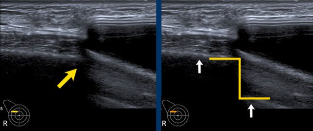 Step off sign in silicone prosthesis
