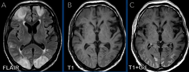 Multiple infarctions in a patient with COVID