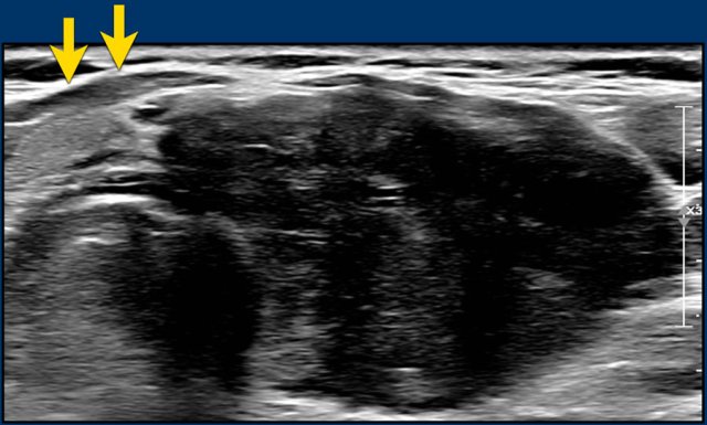 Very hypoechoic , i.e. 3 points in TI-RADS.