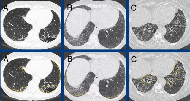 Subpleural dominant (A), subpleural sparing (B), and peribronchial dominant (C) patterns of fibrosis.