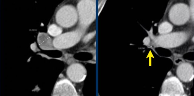 Lymph node target lesion 18mm at baseline (left). At follow up only 4mm.