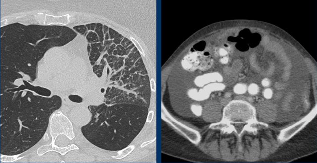 Non-measurable lesions