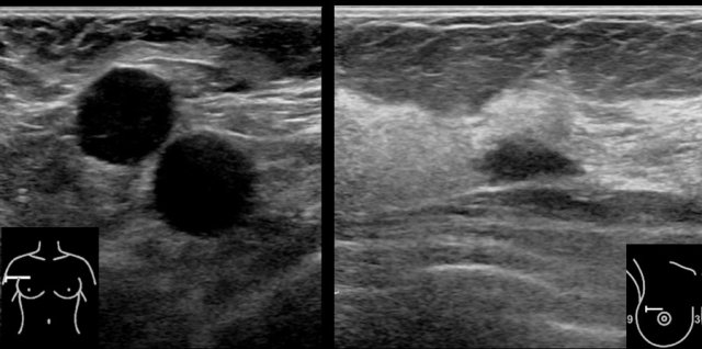 Large axillary lymph node metastases of a small irregular carcinoma