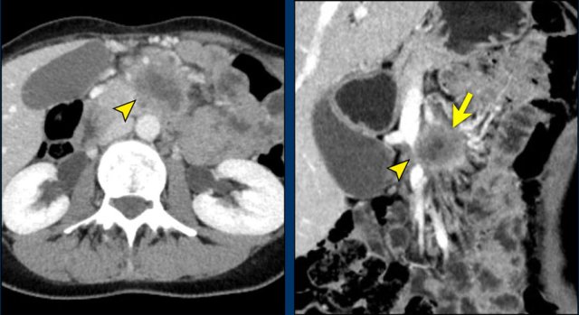 Axial CT shows a mass in the uncinate process (arrowhead). The coronal reformat shows invasion of the mesentery as demonstrated by encasement of a major SMV tributary (arrowhead) and separate obstruction of proximal jejunal veins (arrow)