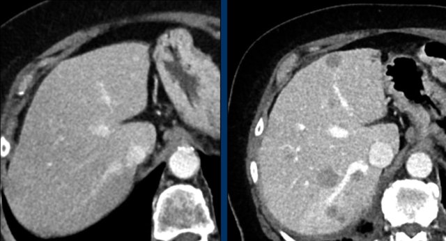 New lesions means progressive disease