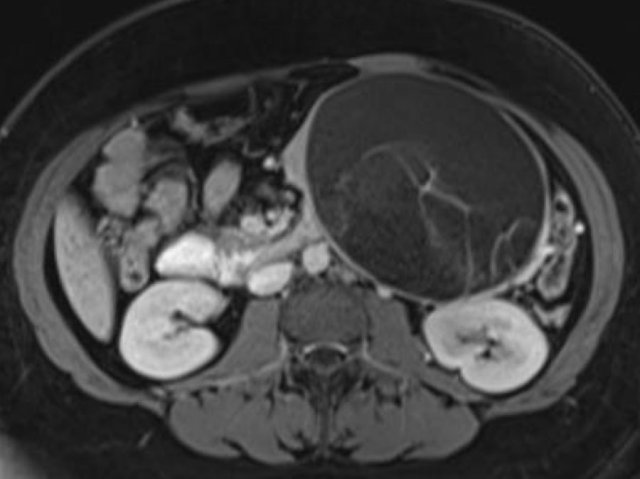 Mucinous cystadenoma.