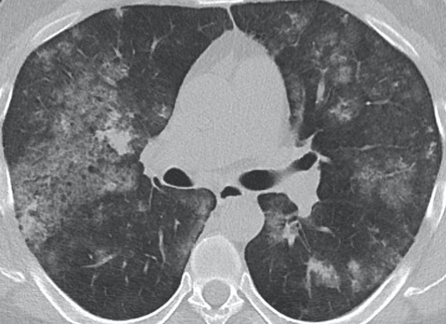 Alveloar hemorrhage in a patient with SLE.