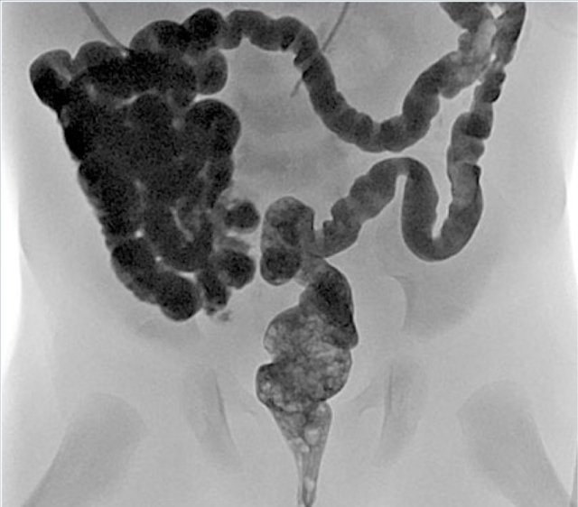 Microcolon: elongated colon with smalldiameter. It indicates that meconium has not reached the colon yet. Once the obstruction is relieved and bowel contents pass through the colon, the colon will develop normally without remaining consequences.