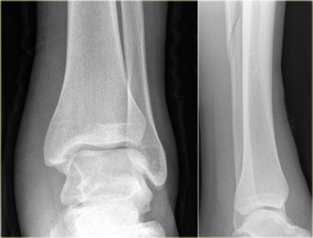 Weber C fracture - at least stage 3