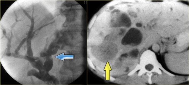 LEFT: Infiltrating cholangiocarcinoma with stricture in a patient with Caroli disease RIGHT: Intraductal cholangiocarcinoma