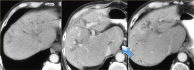 Primary sclerosing cholangitis. late CT findings