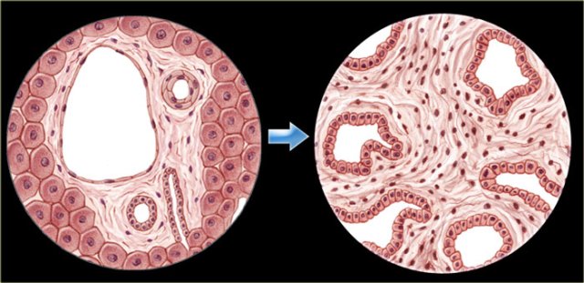 Normal columnar epithelium (left) transforms into adenocarcinoma (right)