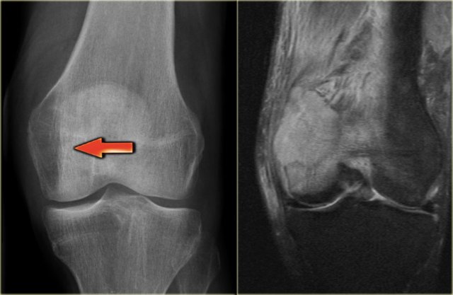 Metastasis in distal femur