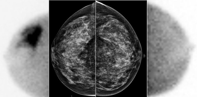 A large tumor in the right breast is easily detected with BSGI, while hardly visible on the mammogram.