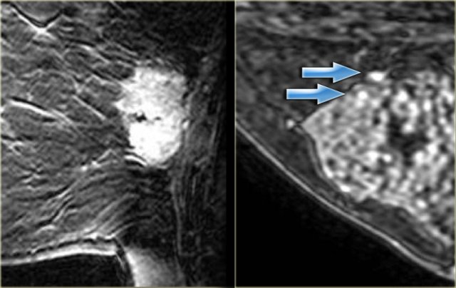 LEFT: Heterogeneous enhancement in invasive ductal carcinomaRIGHT: Punctate enhancement in a hamartoma with fibrocystic change (arrows)
