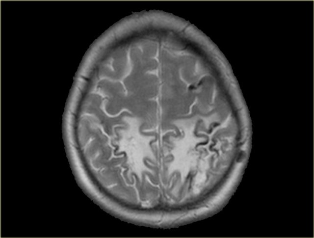 Bilateral infarction in superior sagittal sinus thrombosis