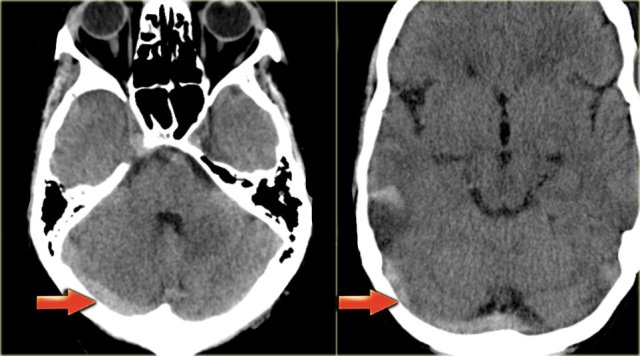 Normal transverse sinus (left) and thrombosed transverse sinus (right).