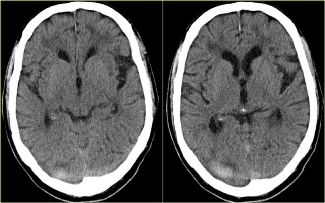 Hematoma mimicking a dense clot sign