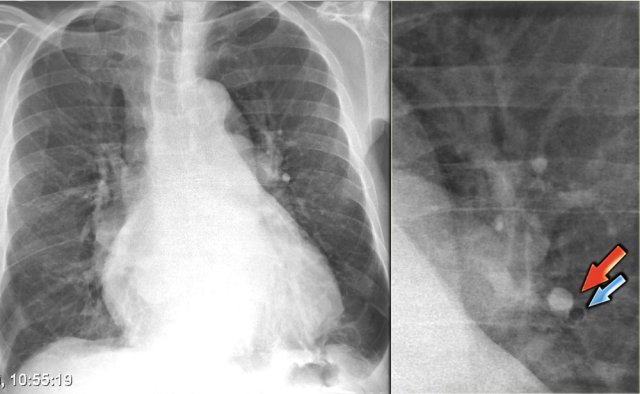 Increased artery-to-bronchus ratio in CHF