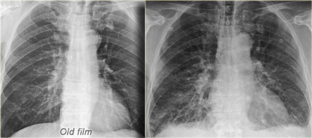 Old film for comparison (left) CHF with redistribution, interstitial edema and some pleural fluid