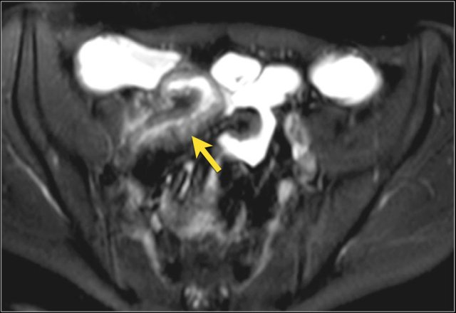Actively inflamed terminal ileum with marked thickening and moderate mural signal intensity (mural edema) on an axial T2 with fat sat.