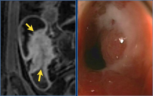 Coronal post-contrast T1 image with a stenosis at the ileocecal junction (left). No obvious pre-stenotic dilatation is seen. The stenosis was non-passable using endoscopy (right).