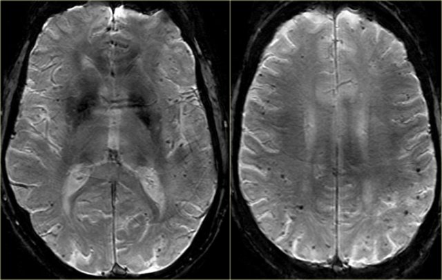 Cerebral Amyloid Angiopathy