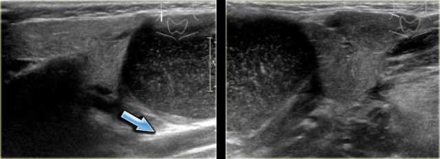 Second branchial cleft cyst