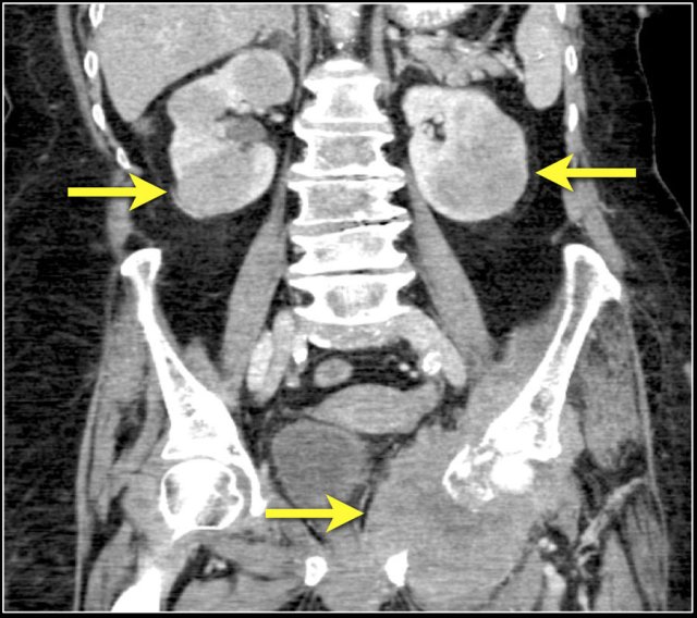 B-cell lymphoma with renal and bone involvement (arrows)