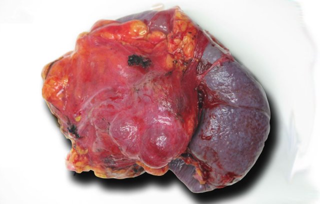 Serous cystic neoplasm.