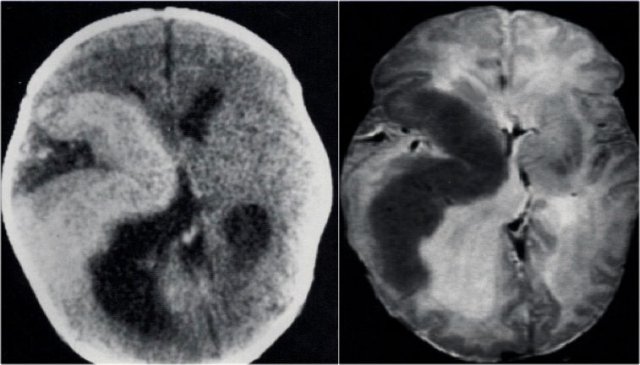 Hemimegalencephaly. Courtesy of Alessandra D'Amico
