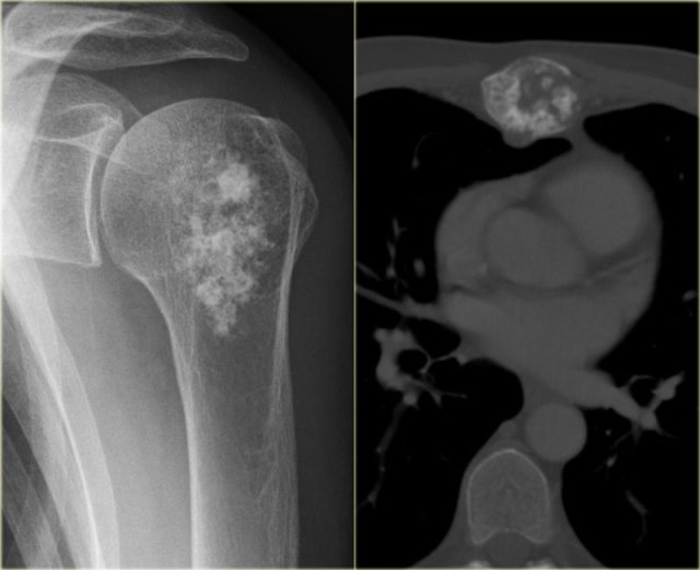 Chondrosarcoma in humeral head and sternum