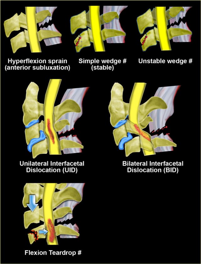 【コーウィン様用】NERVE / Fracture Maisonneuve fracture - Wikipedia