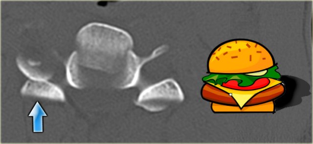 Inverted hamburger sign in unilateral interfacetal dislocation