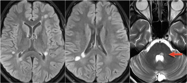Typical MS in the brain