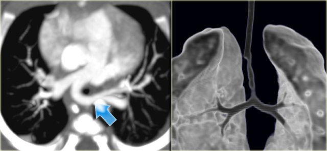 Pulmonary Sling with long segment stenosis of the trachea. (Courtesy J. Schoef)