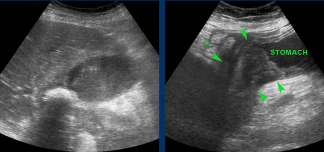 Bouveret syndrome