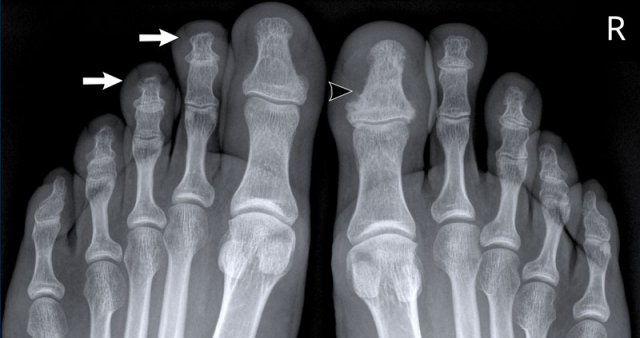 Psoriatic arthritis