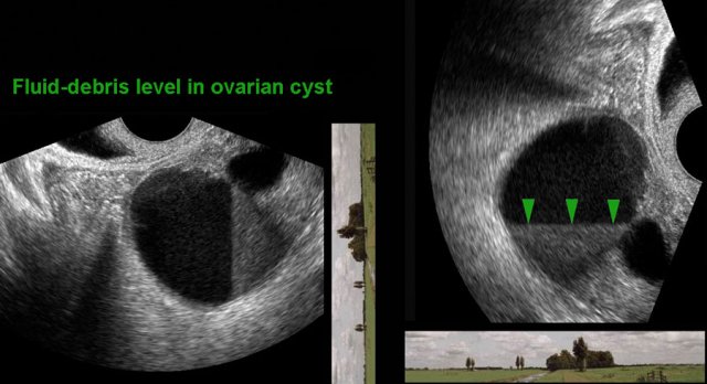 Fluid-debris-level in endometriotic cyst