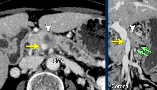 Irregularity of the SMV (yellow arrow)