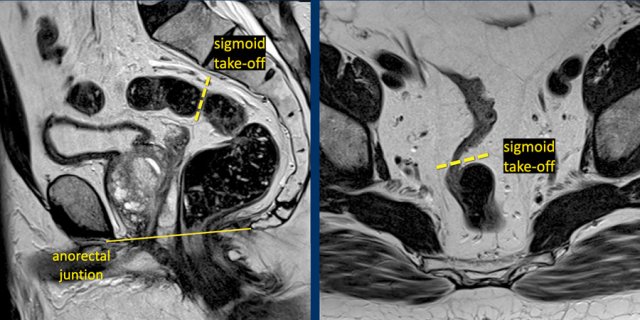 The stippled line indicates the sigmoid take-off on a sagittal and axial view