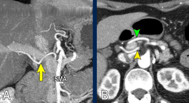 Replaced right hepatic artery