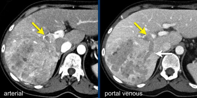 LR-tumor in vein