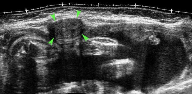 Necrotic myoma in pregnancy