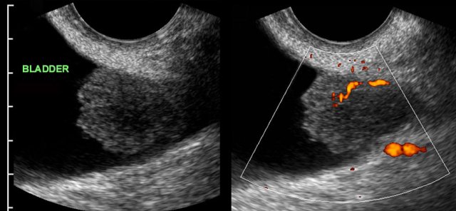 Malignant bladder polyp: coincidental finding by gynaecologist.