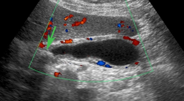 US performed 5 hours after the pain episode. There is both reperfusion edema and hyperemia of the gallbladder wall. The obstructing stone  (arrow) is still visible in the neck, but there was no hydrops