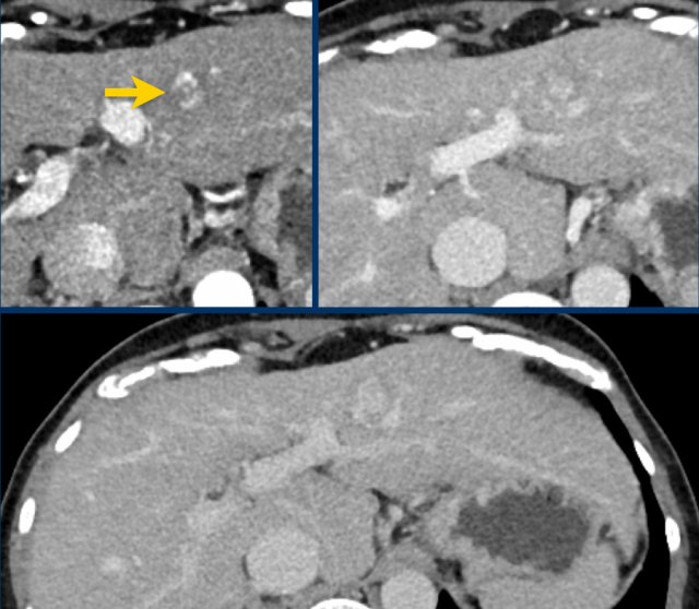 Typical haemangioma in a patient with livercirrhosis.