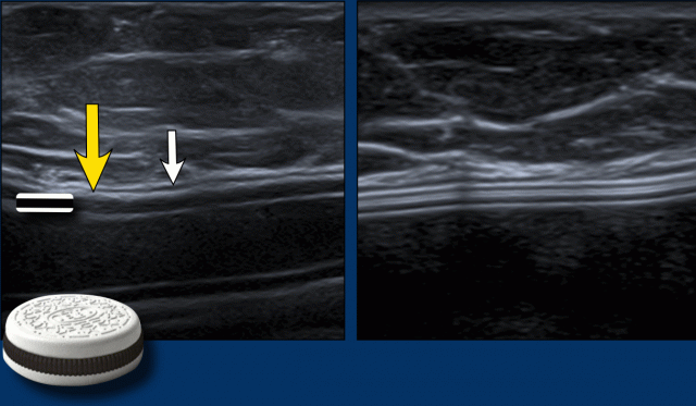 Envelope (yellow arrow) and capsule (white arrow) anterior to the envelope