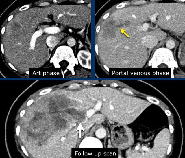 LR-tumor in vein