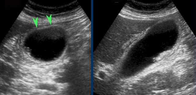 Acute pancreatitis simulating acute cholecystitis